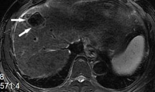 原发性肝癌 原发性肝癌